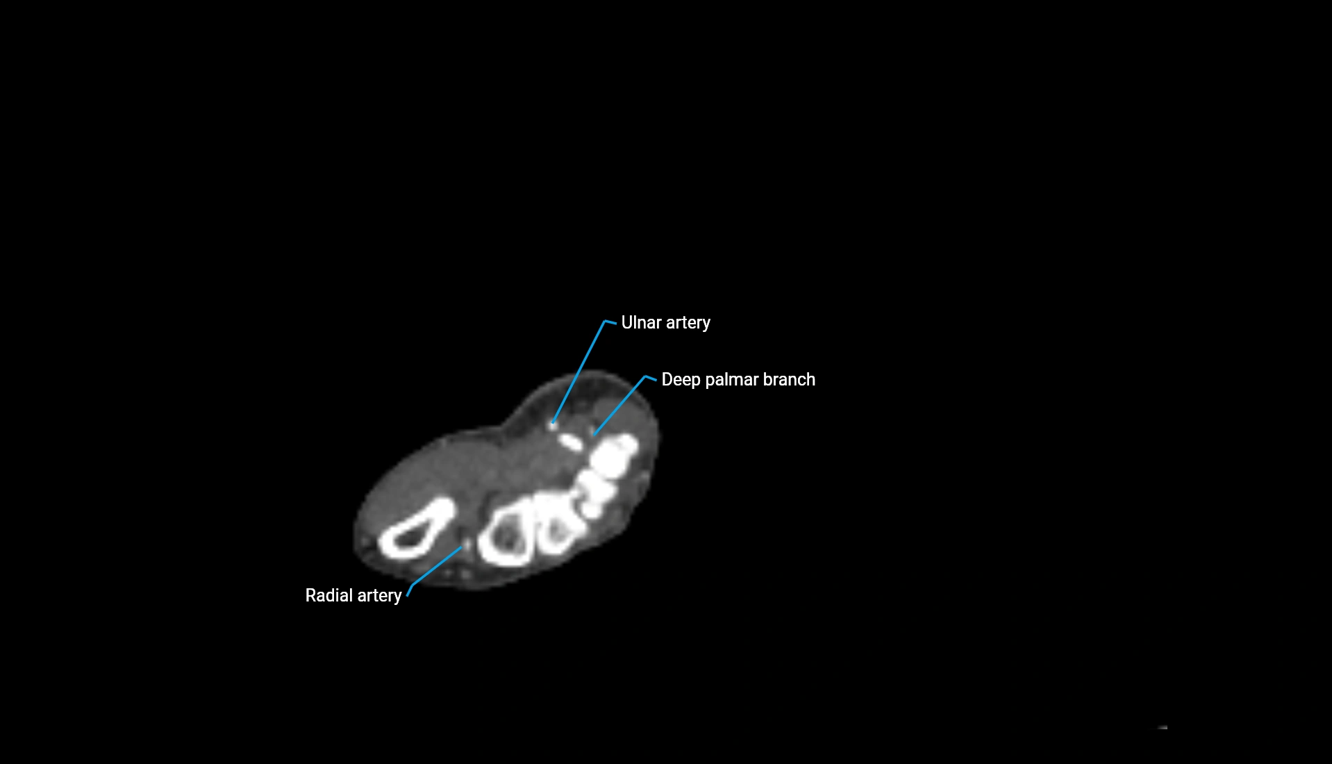 CTA upper limb axial cross sectional anatomy labelled image 68 (2).webp